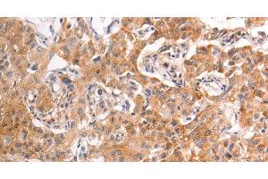 Immunohistochemistry of paraffin-embedded Human liver cancer tissue using TRPV4 Polyclonal Antibody at dilution 1:40 (TRPV4 Antikörper)
