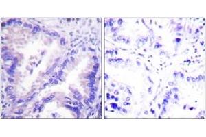 Immunohistochemistry analysis of paraffin-embedded human lung carcinoma tissue, using PP2A-alpha (Ab-307) Antibody.