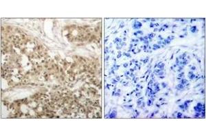 Immunohistochemistry analysis of paraffin-embedded human breast carcinoma, using PKC thet (Phospho-Ser676) Antibody. (PKC theta Antikörper  (pSer676))
