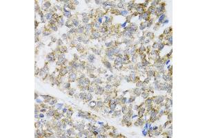 Immunohistochemistry of paraffin-embedded human esophageal cancer using ZAK antibody. (ZAK Antikörper)