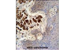 COL19A1 antibody (N-term) (ABIN654432 and ABIN2844168) immunohistochemistry analysis in formalin fixed and paraffin embedded human skin carcinoma followed by peroxidase conjugation of the secondary antibody and DAB staining. (COL19A1 Antikörper  (N-Term))
