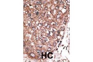 Formalin-fixed and paraffin-embedded human hepatocellular carcinoma tissue reacted with HAND2 polyclonal antibody  , which was peroxidase-conjugated to the secondary antibody, followed by AEC staining. (HAND2 Antikörper  (C-Term))