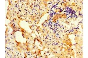 Immunohistochemistry of paraffin-embedded human lung cancer using ABIN7168333 at dilution of 1:100 (RBM12 Antikörper  (AA 1-200))