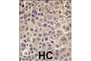 Formalin-fixed and paraffin-embedded human hepatocarcinoma tissue reacted with MTMR9 antibody , which was peroxidase-conjugated to the secondary antibody, followed by DAB staining. (MTMR9 Antikörper  (C-Term))
