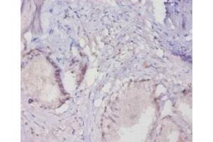 Immunohistochemistry of paraffin-embedded human prostate tissue using ABIN7160281 at dilution of 1:20 (MUC16 Antikörper  (AA 14067-14328))