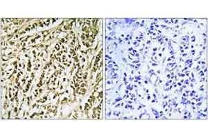Immunohistochemistry analysis of paraffin-embedded human breast carcinoma tissue, using FEN1 Antibody.