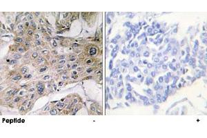 Immunohistochemistry analysis of paraffin-embedded human breast carcinoma tissue using COX7A2P2 polyclonal antibody . (COX7A2P2 Antikörper)
