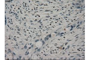 Immunohistochemical staining of paraffin-embedded Adenocarcinoma of colon tissue using anti-CRYABmouse monoclonal antibody. (CRYAB Antikörper)