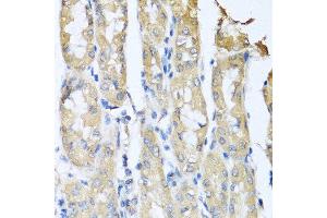Immunohistochemistry of paraffin-embedded human gastric cancer using CCL3 antibody at dilution of 1:100 (40x lens). (CCL3 Antikörper)