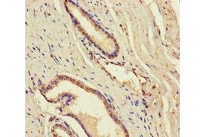 Immunohistochemistry of paraffin-embedded human prostate cancer using ABIN7144980 at dilution of 1:100 (DDX19A Antikörper  (AA 1-478))