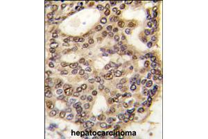 Formalin-fixed and paraffin-embedded human hepatocellular carcinoma reacted with HDGF polyclonal antibody  , which was peroxidase-conjugated to the secondary antibody, followed by DAB staining . (HDGF Antikörper  (C-Term))
