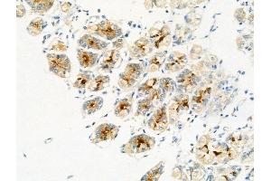 Phospho-MAFB (Ser304) Antibody at 1/100 staining Human gastric cancer and adjacent normal tissues by IHC-P.