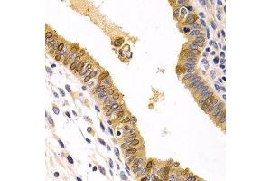Immunohistochemistry of paraffin-embedded human uterine cancer using CXCR3 Antibody.