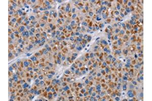The image on the left is immunohistochemistry of paraffin-embedded Human liver cancer tissue using ABIN7190333(COX18 Antibody) at dilution 1/20, on the right is treated with synthetic peptide. (COX18 Antikörper)