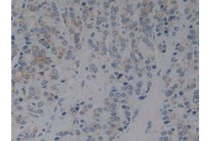 Detection of IkBb in Human Prostate Gland Cancer Tissue using Polyclonal Antibody to Inhibitory Subunit Of NF Kappa B Beta (IkBb) (Inhibitory Subunit of NF kappa B beta (AA 85-332) Antikörper)