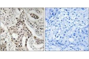 Immunohistochemistry analysis of paraffin-embedded human breast carcinoma, using NCoA2 (Phospho-Ser736) Antibody. (NCOA2 Antikörper  (pSer736))