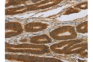 The image on the left is immunohistochemistry of paraffin-embedded Human colon cancer tissue using ABIN7191676(NOTCH4 Antibody) at dilution 1/30, on the right is treated with synthetic peptide.