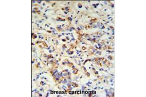 DCT Antibody IHC analysis in formalin fixed and paraffin embedded breast carcinoma followed by peroxidase conjugation of the secondary antibody and DAB staining. (DCT Antikörper  (N-Term))