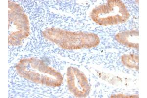 Formalin-fixed, paraffin-embedded human endo-cervical carcinoma stained with Interleukin 10 Recombinant Rabbit Monoclonal Antibody (IL10/2651R). (Rekombinanter IL-10 Antikörper)