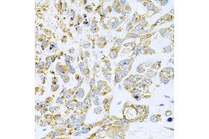 Immunohistochemistry of paraffin-embedded human lung cancer using HDAC3 antibody.
