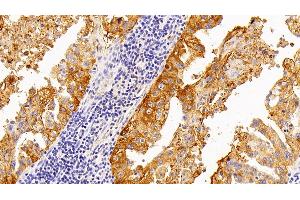 Detection of SPA2 in Human Lung cancer Tissue using Polyclonal Antibody to Surfactant Associated Protein A2 (SPA2) (SFTPA2 Antikörper  (AA 21-114))