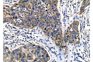 ABIN6262495 and ABIN6277945 at 1/100 staining Human esophageal cancer by IHC-P. (IGFBP2 Antikörper  (C-Term))