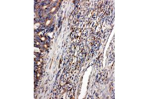 Anti-CD163 antibody,  IHC(P) IHC(P): Human Intestinal Cancer Tissue
