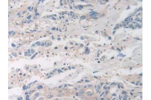 Used in DAB staining on fromalin fixed paraffin- embedded glioma tissue