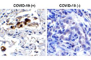Immunohistochemistry Validation of SARS-CoV-2 (COVID-19) Spike RBD in COVID-19 Patient Lung Immunohistochemical analysis of paraffin-embedded COVID-19 patient lung tissue using anti- SARS-CoV-2 (COVID-19) Spike RBD antibody (ABIN6952968, 0. (SARS-CoV-2 Spike Antikörper  (RBD))