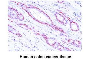 Paraffin embedded sections of human colon cancer tissue were incubated with anti-human MAT2A (1:50) for 2 hours at room temperature. (MAT2A Antikörper)
