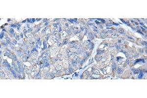 Immunohistochemistry of paraffin-embedded Human breast cancer tissue using PRKAR2A Polyclonal Antibody at dilution of 1:50(x200) (PRKAR2A Antikörper)