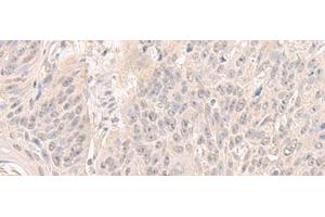 Immunohistochemistry of paraffin-embedded Human esophagus cancer tissue using HENMT1 Polyclonal Antibody at dilution of 1:30(x200) (HENMT1 Antikörper)