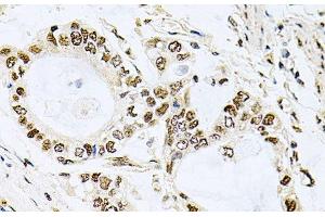 Immunohistochemistry of paraffin-embedded Human gastric cancer using MCL1 Polyclonal Antibody at dilution of 1:100 (40x lens). (MCL-1 Antikörper)