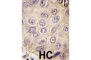 Formalin-fixed and paraffin-embedded human hepatocellular carcinoma reacted with EDA polyclonal antibody  , which was peroxidase-conjugated to the secondary antibody, followed by DAB staining.