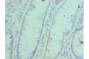 Immunohistochemistry of paraffin-embedded human colon cancer using ABIN7143052 at dilution of 1:100 (BAF53A Antikörper  (AA 1-280))