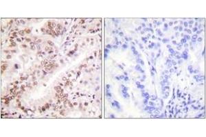 Immunohistochemistry analysis of paraffin-embedded human lung carcinoma, using Estrogen Receptor-alpha (Phospho-Tyr537) Antibody. (Estrogen Receptor alpha Antikörper  (pTyr537))