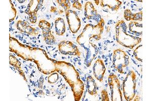 ABIN6258581 and ABIN6274584 at 1/100 staining Human kidney cancer and adjacent normal tissues by IHC-P. (beta 2 Adrenergic Receptor Antikörper  (C-Term))