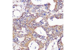 Immunohistochemistry of paraffin-embedded Human colon carcinoma using TUBGCP6 Rabbit pAb (ABIN7271055) at dilution of 1:100 (40x lens). (GCP6 Antikörper  (AA 600-900))