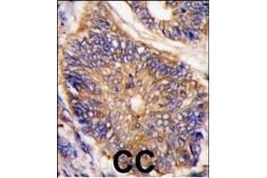 Formalin-fixed and paraffin-embedded human colon carcinoma tissue reacted with LDLR antibody (N-term) (ABIN392553 and ABIN2842100) , which was peroxidase-conjugated to the secondary antibody, followed by DAB staining. (LDLRAP1 Antikörper  (N-Term))