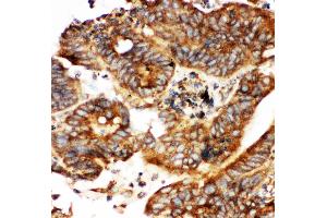 Anti-Calbindin Picoband antibody,  IHC(P): Human Intestinal Cancer Tissue
