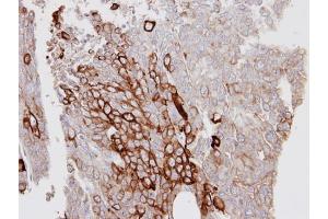 IHC-P Image Immunohistochemical analysis of paraffin-embedded D54MG xenograft, using KRT6A, antibody at 1:100 dilution. (KRT6A Antikörper)