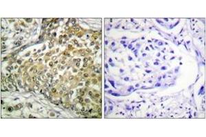 Immunohistochemistry analysis of paraffin-embedded human lung carcinoma tissue, using p53 (Acetyl-Lys379) Antibody. (p53 Antikörper  (acLys381))