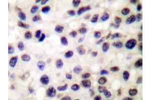 Immunohistochemistry analyzes of Stat5b antibody in paraffin-embedded human colon carcinoma tissue. (STAT5B Antikörper)