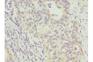 Immunohistochemistry of paraffin-embedded human bladder cancer using ABIN7144072 at dilution of 1:100 (ANAPC2 Antikörper  (AA 1-230))