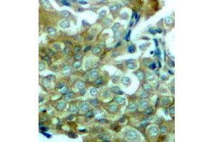 Immunohistochemistry (IHC) image for anti-Epidermal Growth Factor Receptor (EGFR) (pTyr1172) antibody (ABIN3019839) (EGFR Antikörper  (pTyr1172))