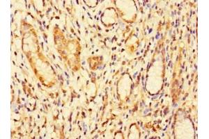 Immunohistochemistry of paraffin-embedded human gastric cancer using ABIN7157917 at dilution of 1:100 (DBR1 Antikörper  (AA 1-220))