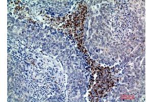 Immunohistochemical analysis of paraffin-embedded human-breast-cancer, antibody was diluted at 1:200 (BATF3 Antikörper  (Internal Region))