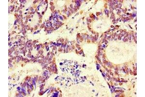 Immunohistochemistry of paraffin-embedded human colon cancer using ABIN7167735 at dilution of 1:100 (RFPL4B Antikörper  (AA 1-263))