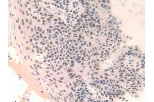 IHC-P analysis of Human Skin Cancer Tissue, with DAB staining. (FAM19A3 Antikörper  (AA 44-130))