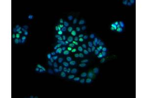 Immunofluorescent staining of human colorectal adenocarcinoma (CDX2 Antikörper)